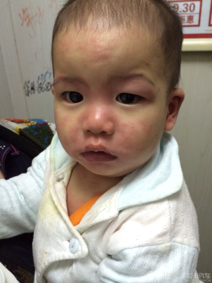 10个月大的娃娃得寻麻疹了,除了输液没别的办