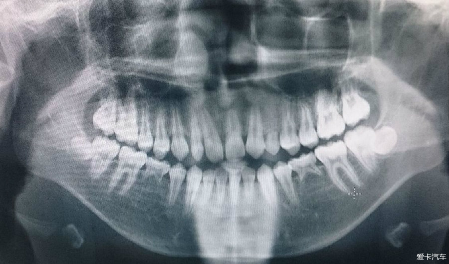 【图】请坛子里的牙医看看,孩子先天性缺牙,应怎么处理_1_深圳论坛