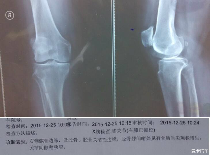 膝关节疼(骨性关节炎),医生说膝关节磨损严重,