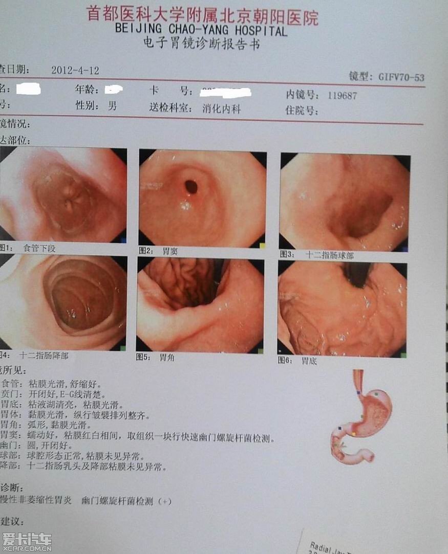 胃镜图片怎么看8个图图片