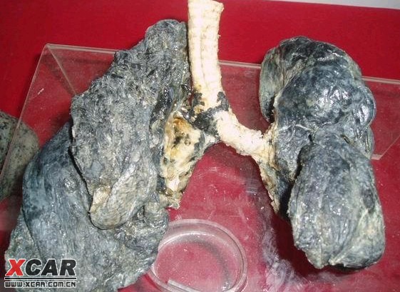 抽烟10年的肺图片