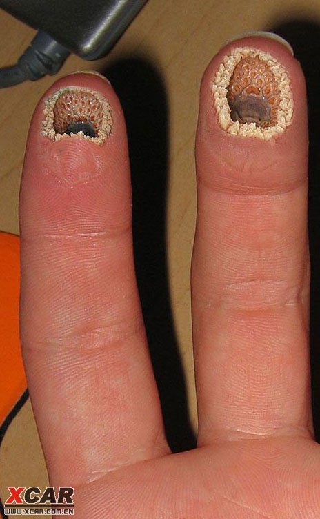 无毒蜘蛛咬的伤口图片图片