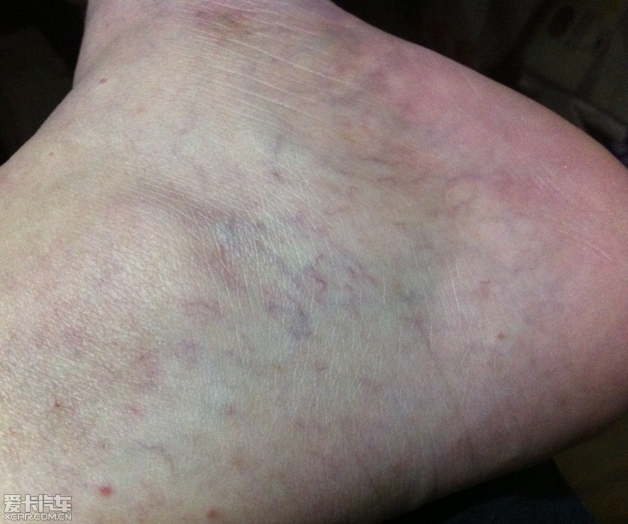 脚踝毛细血管发紫图片