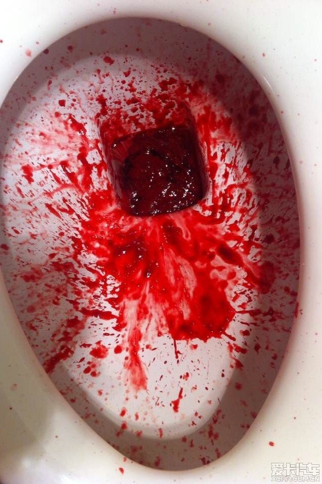 吐血真实照片 胃出血图片