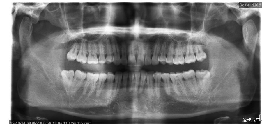 > 今天去拍了全景牙片,醫生說這口牙還湊合