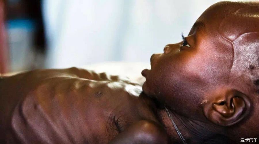 2016 10 13 阅读时间~~~   南苏丹营养不良儿童日增 孩子皮包骨头令人