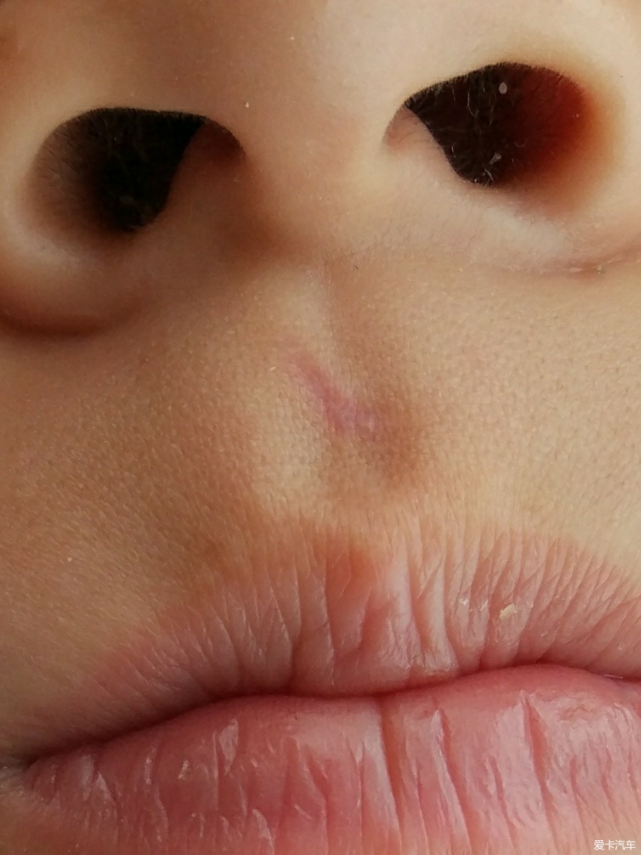 唇裂补过的疤痕图片图片
