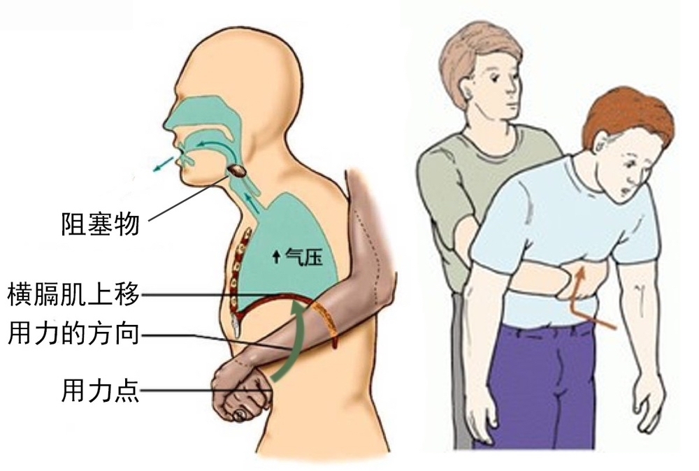 没想到今天用上了海姆立克急救法